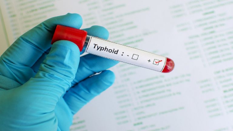 Typhoid Test Everything You Need to Know